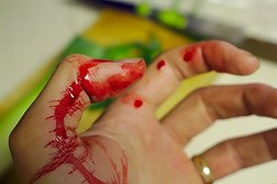 Cut on hand